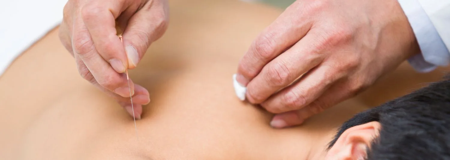 Unlocking the Healing Power of Acupuncture: Ancient Techniques for Modern  Wellness - LiverPool Street Physiotherapy
