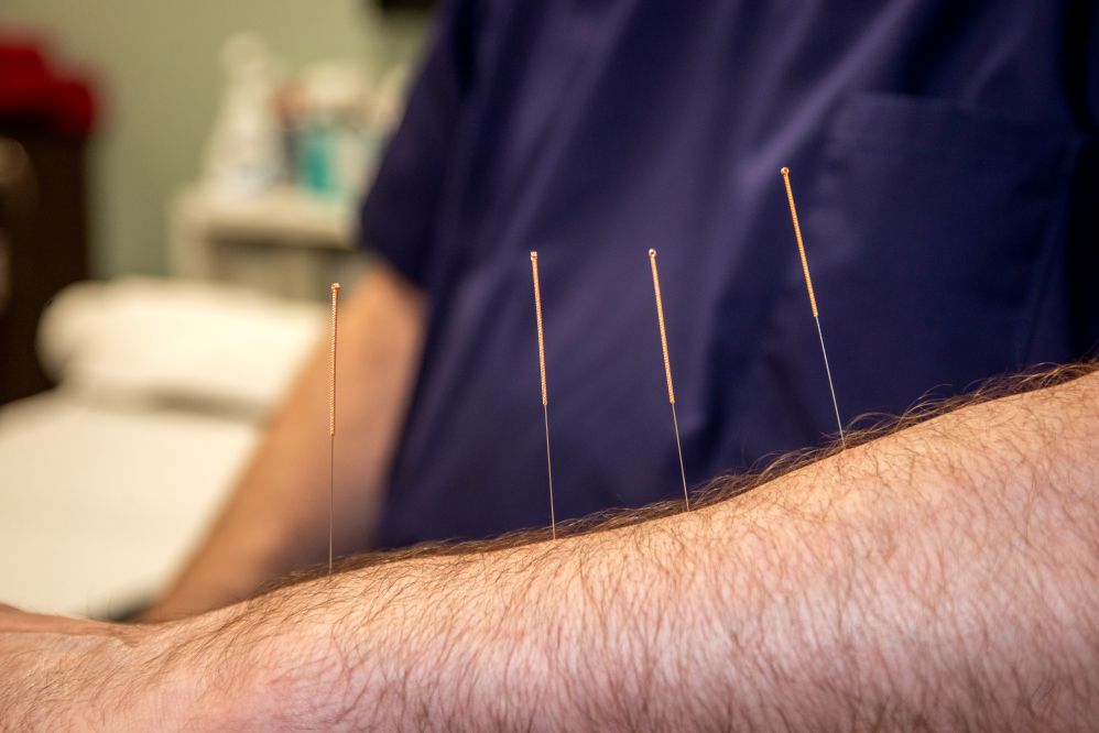 acupuncture img